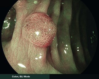 Colon, BLI Mode
