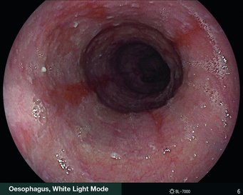 Oesophagus White Light Mode